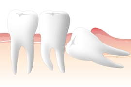 ある矯正専門医が考える第3大臼歯（親知らず）の利用価値